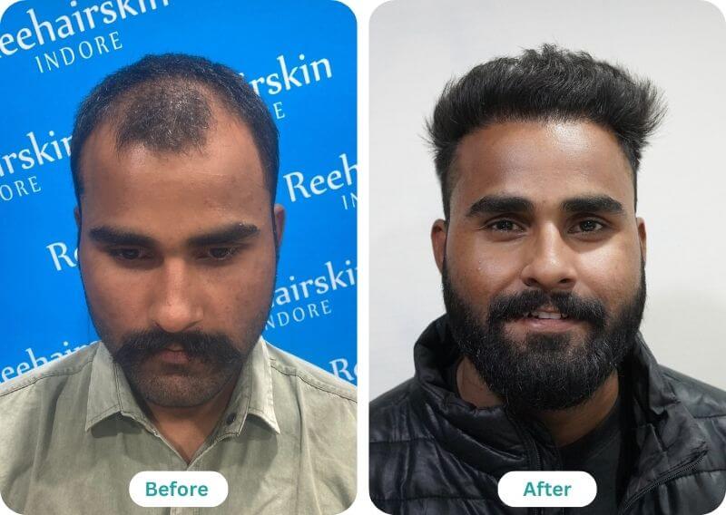 Hair Transplant before and after result